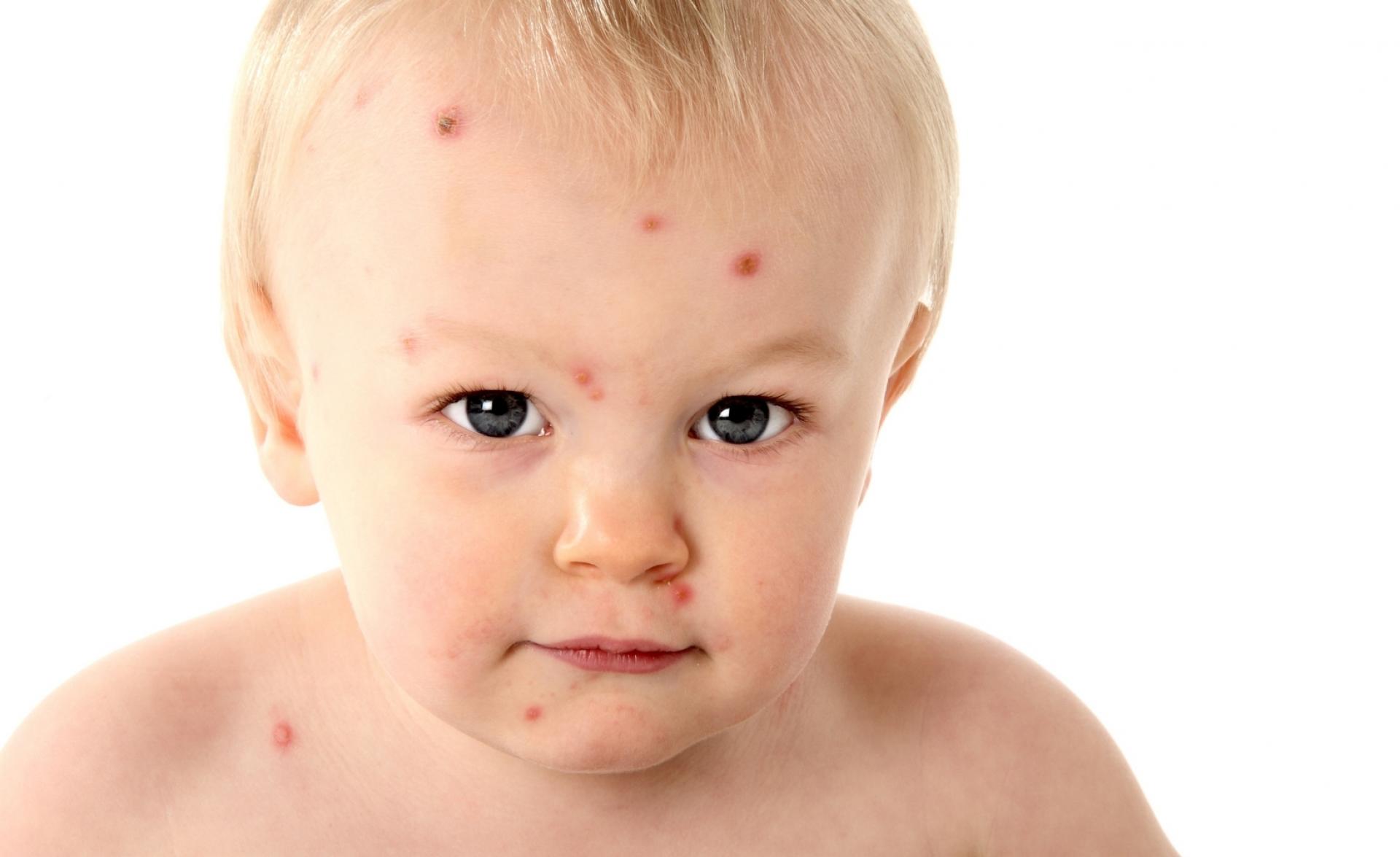 小男孩身上长了水痘。水痘是一种由水痘带状疱疹病毒引起的感染。它最初是起源于面部和躯干的水疱状皮疹照片摄影图片_ID:342846937-Veer图库